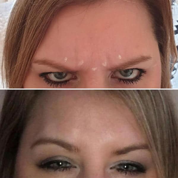 Before and after Botox / anti-wrinkle/ Botox treatment for frown lines by Dr Kara Cosmetic Clinic