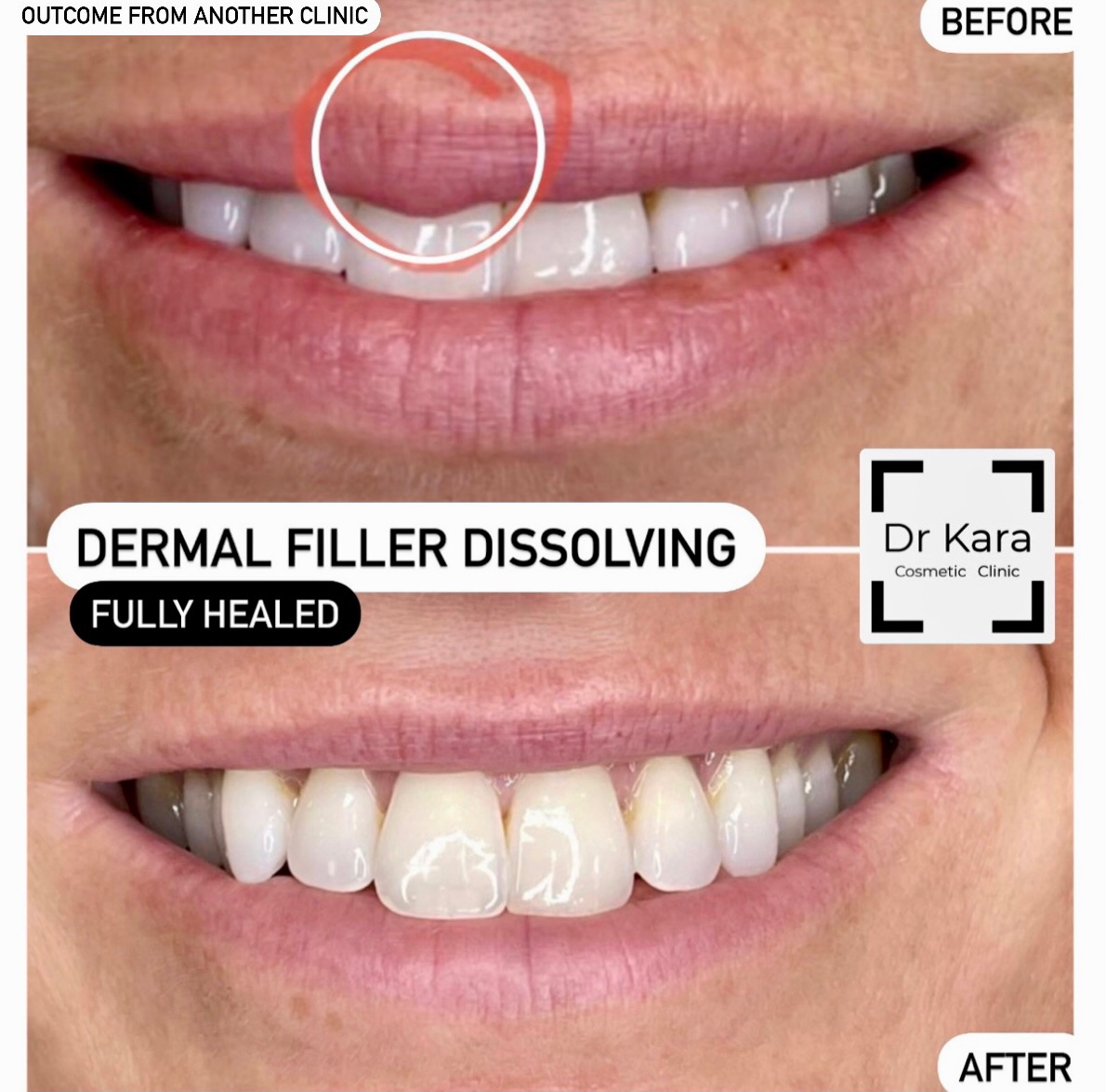 Lip filler dissolving by Dr Kara cosmetic clinic