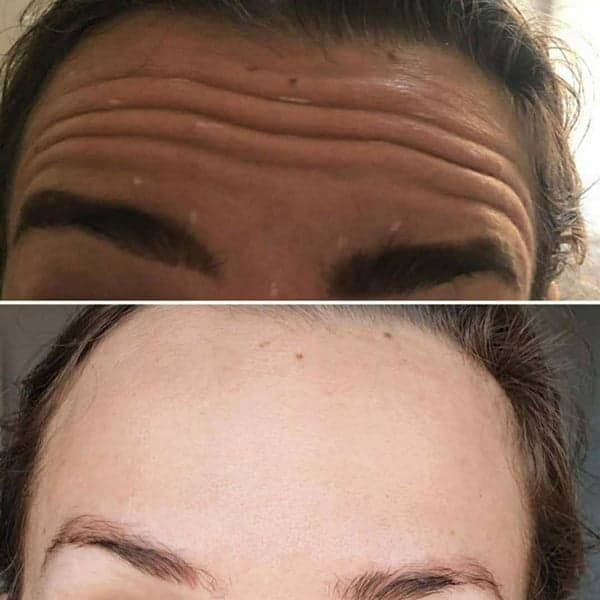Before and after anti-wrinkle / Botox treatment for forehead lines.