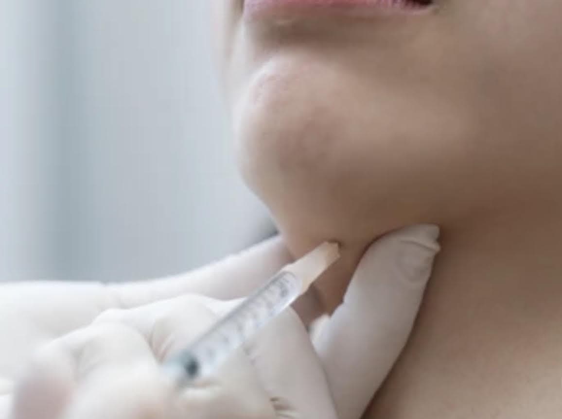Fat dissolving chin injection