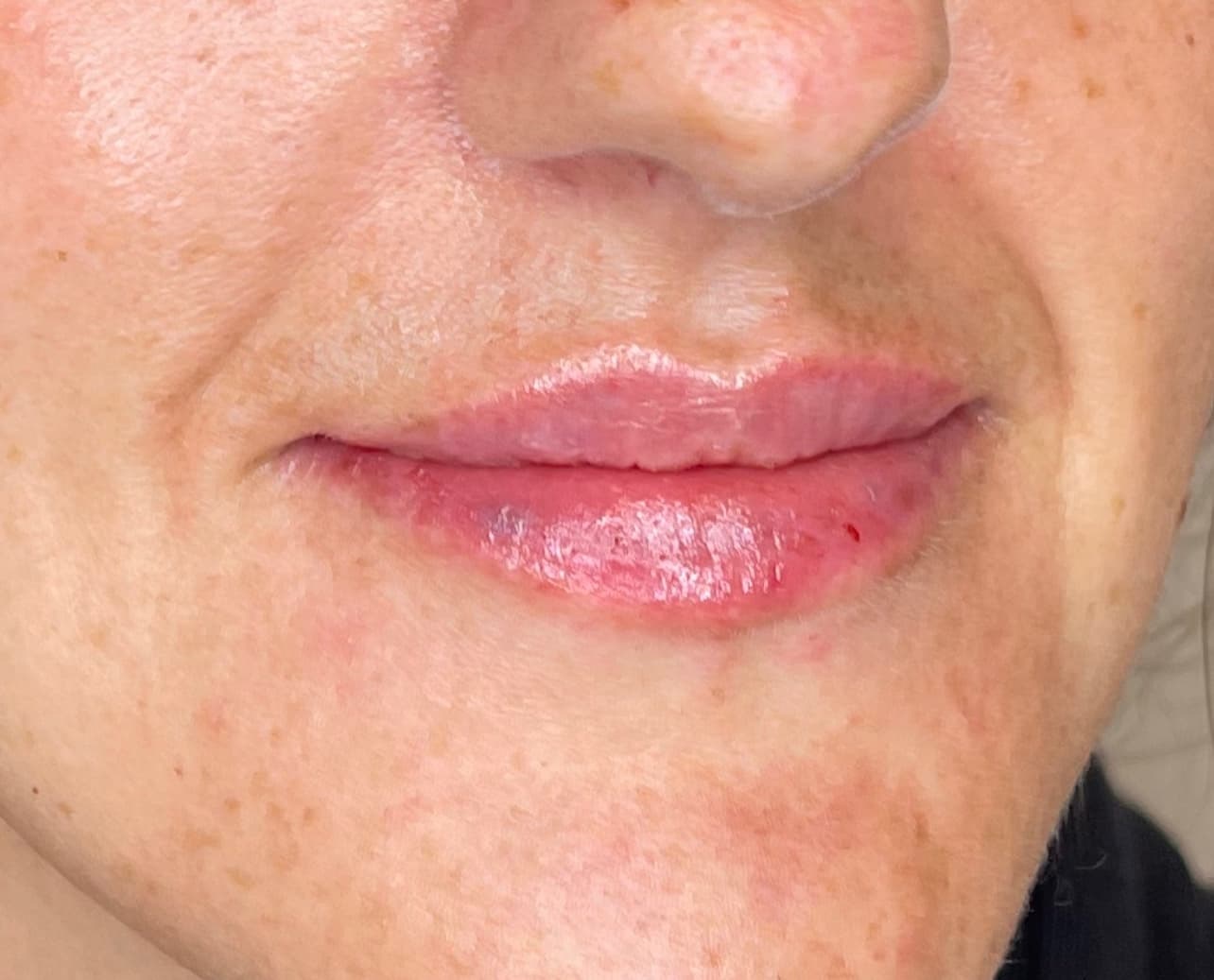 Lip filler result by Dr Kara Cosmetic Clinic in Norwich, Norfolk, UK
