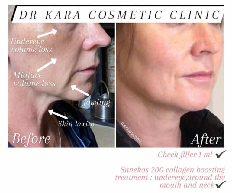 Sagging skin / jowls Dr Kara Cosmetic Clinic
