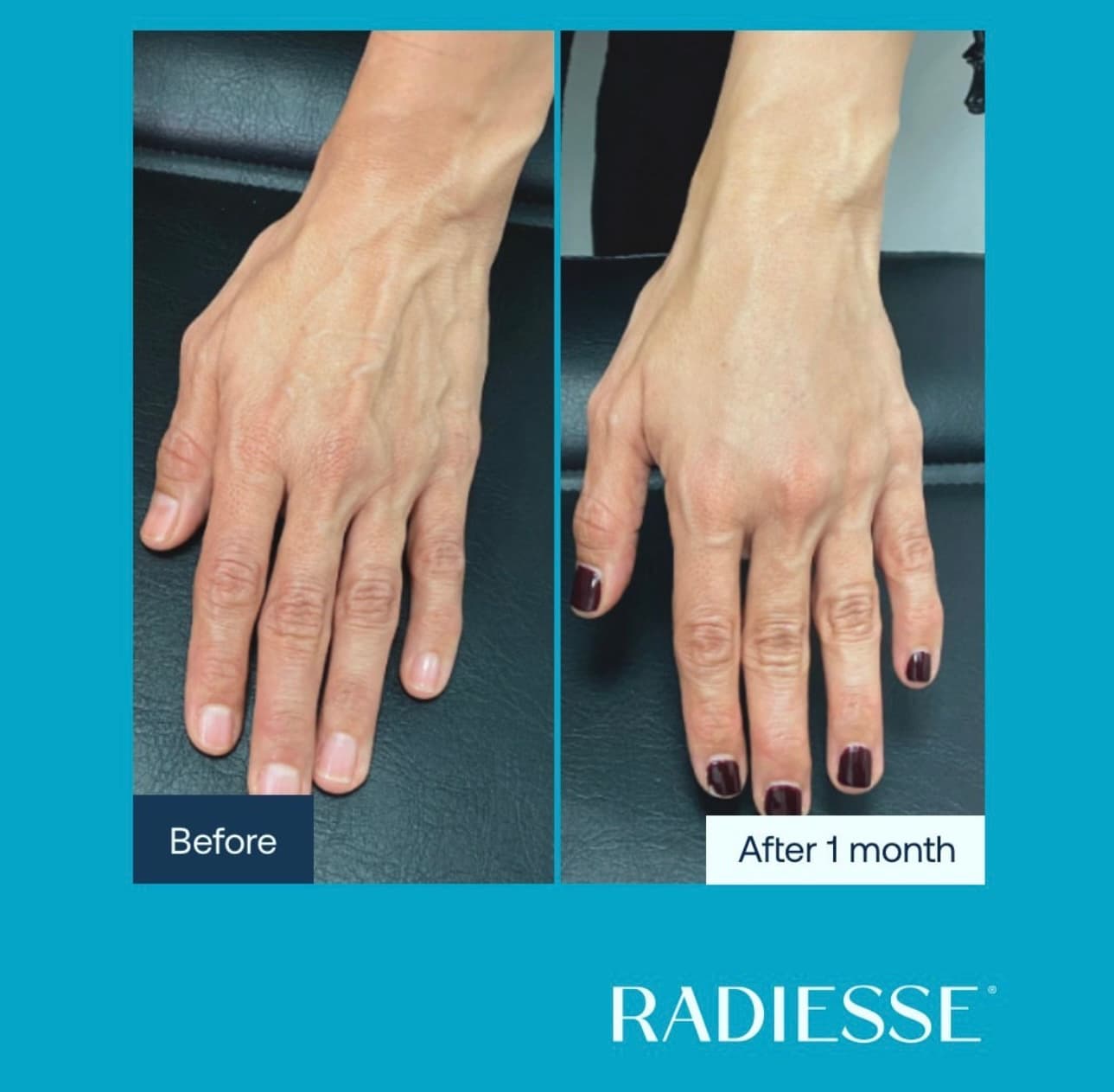 Radiesse Norwich Norfolk Hand before and after