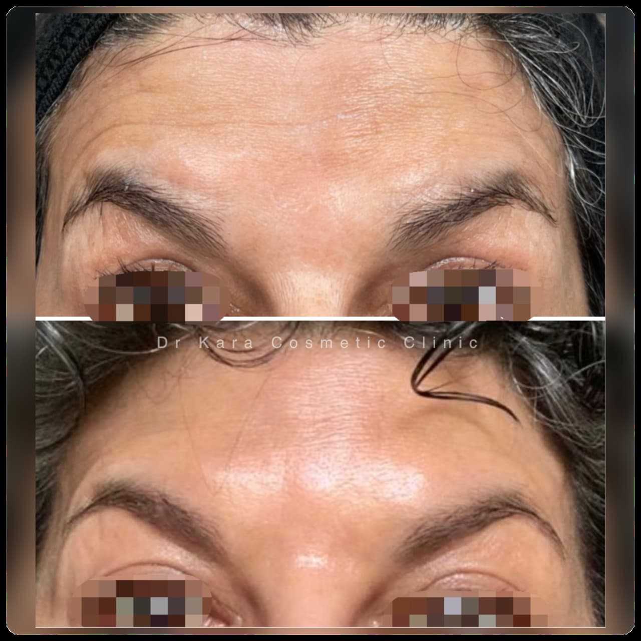 Botox forehead result by Dr Kara Cosmetic Clinic , Norwich , Norfolk