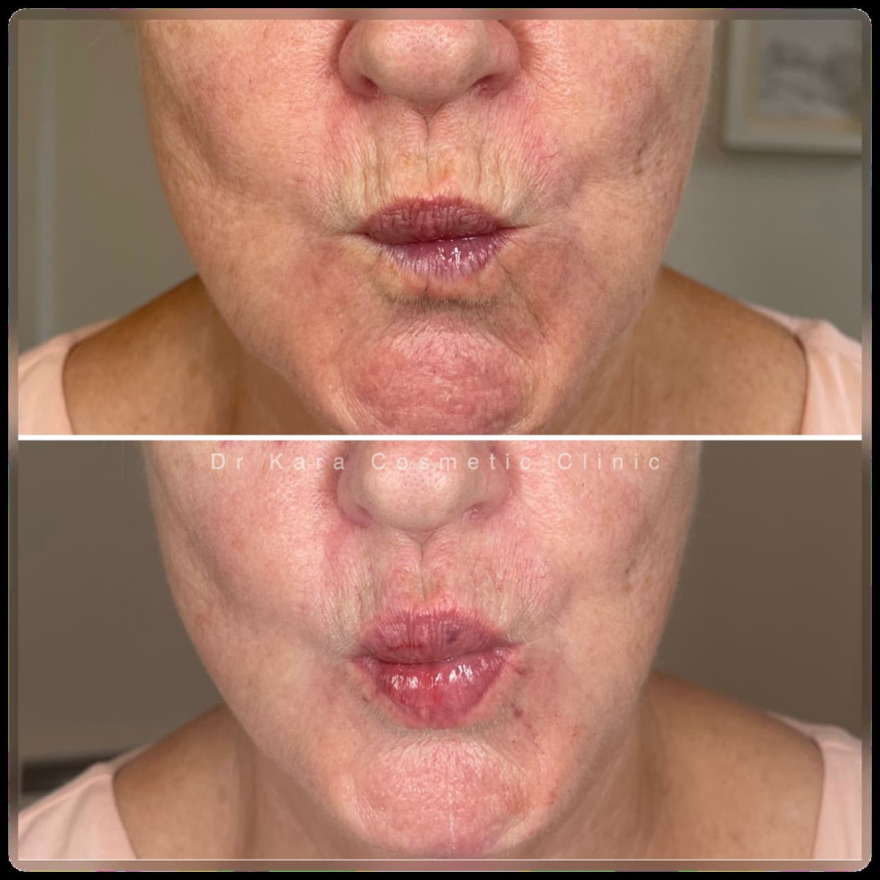 Smoker's lines dermal filler result by Dr Kara Cosmetic Clinic, Norwich , Norfolk