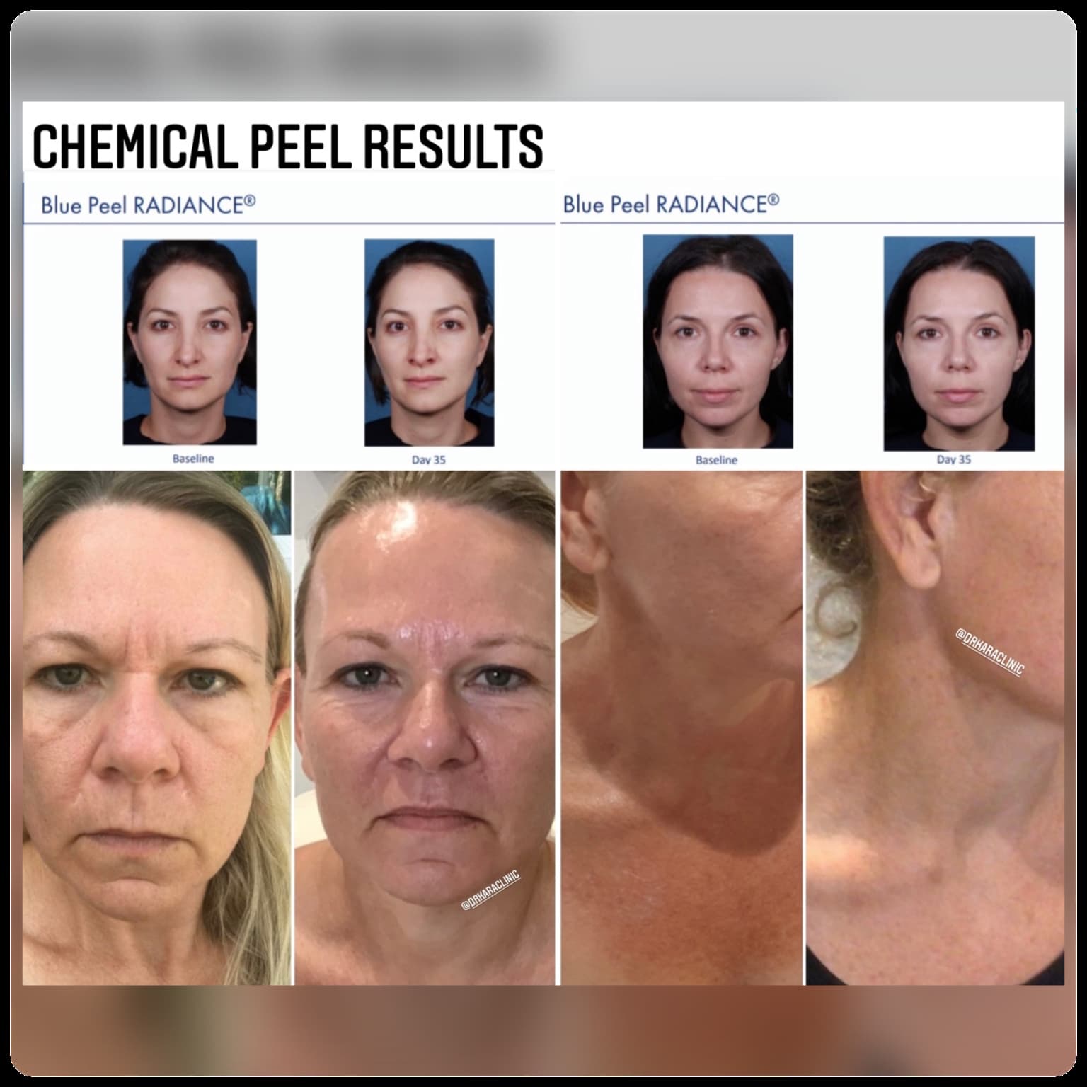 Blue Peel Radiance Chemical peel by Dr Kara Cosmetic Clinic , Norwich, Norfolk