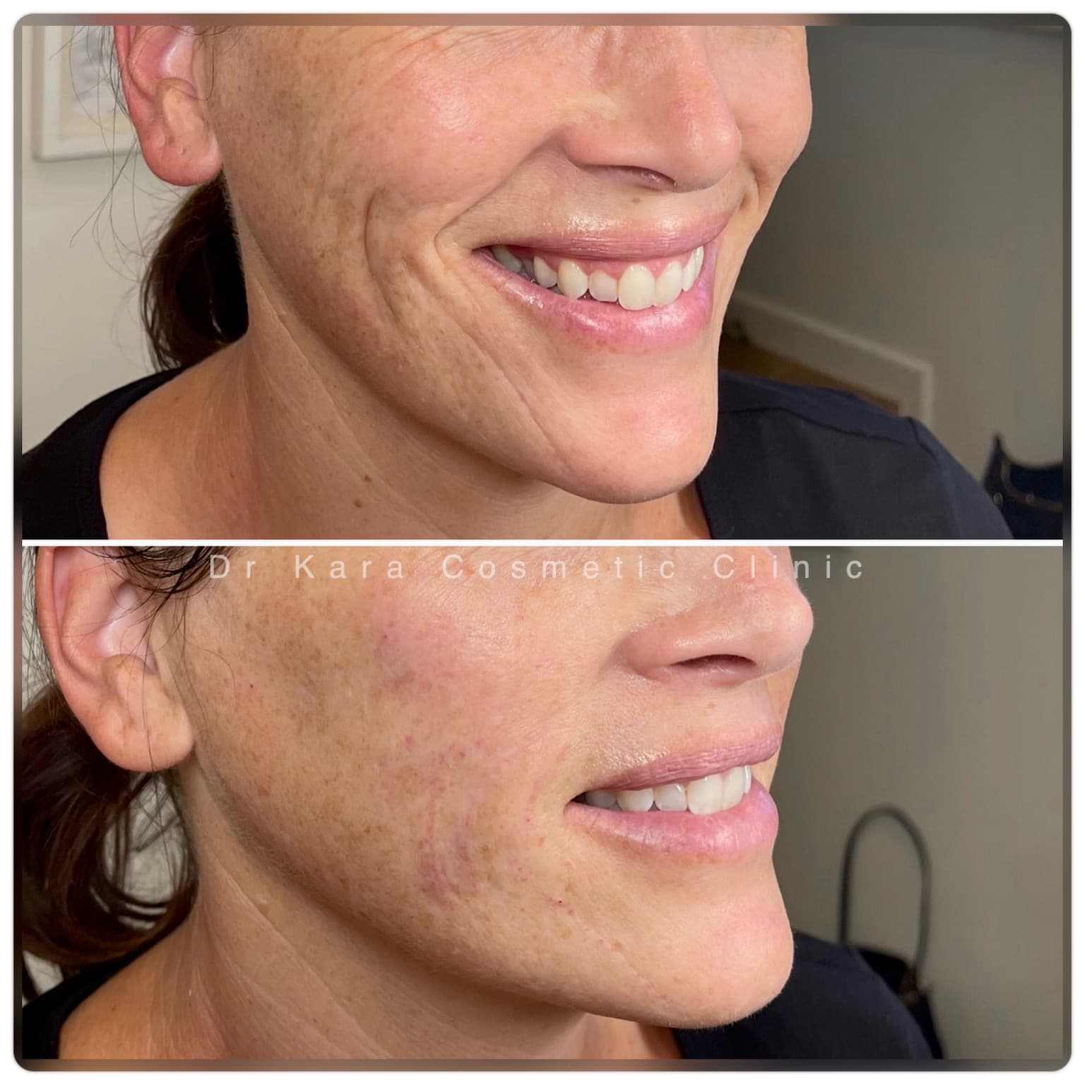 Smile lines dermal filler result by Dr Kara Cosmetic Clinic , Norwich , Norfolk