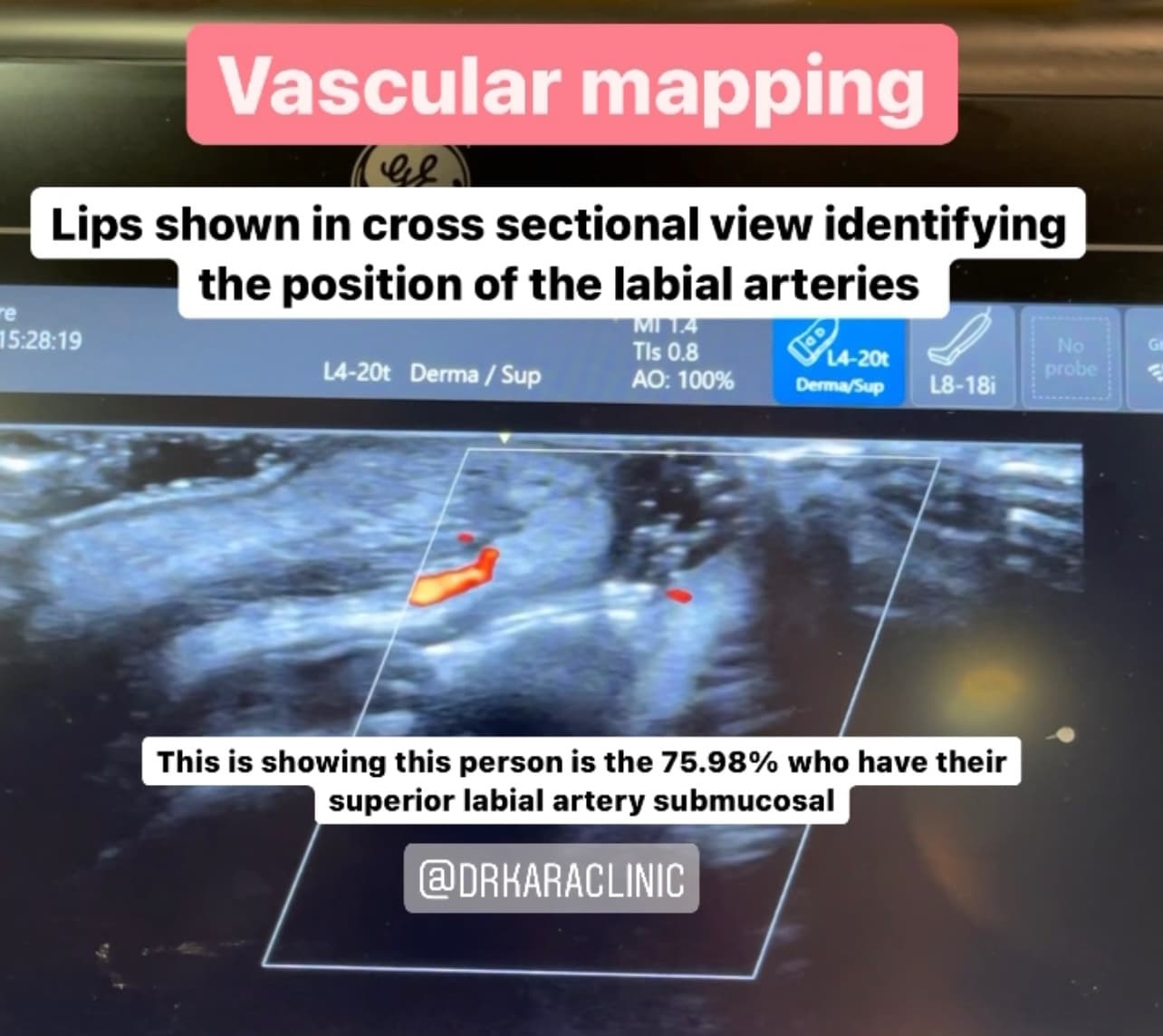 Vascular mapping lips using facial cosmetic / aesthetic ultrasound, by Dr Kara Cosmetic Clinic