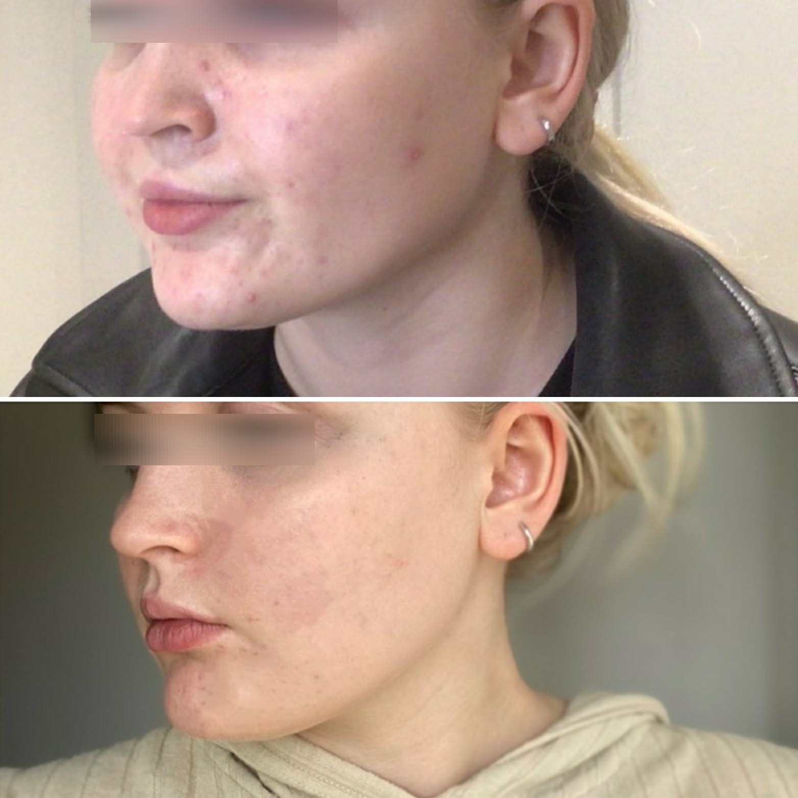 Jawline dermal filler result before and after photos by Dr Kara Cosmetic Clinic, Norwch , Norfolk , UK