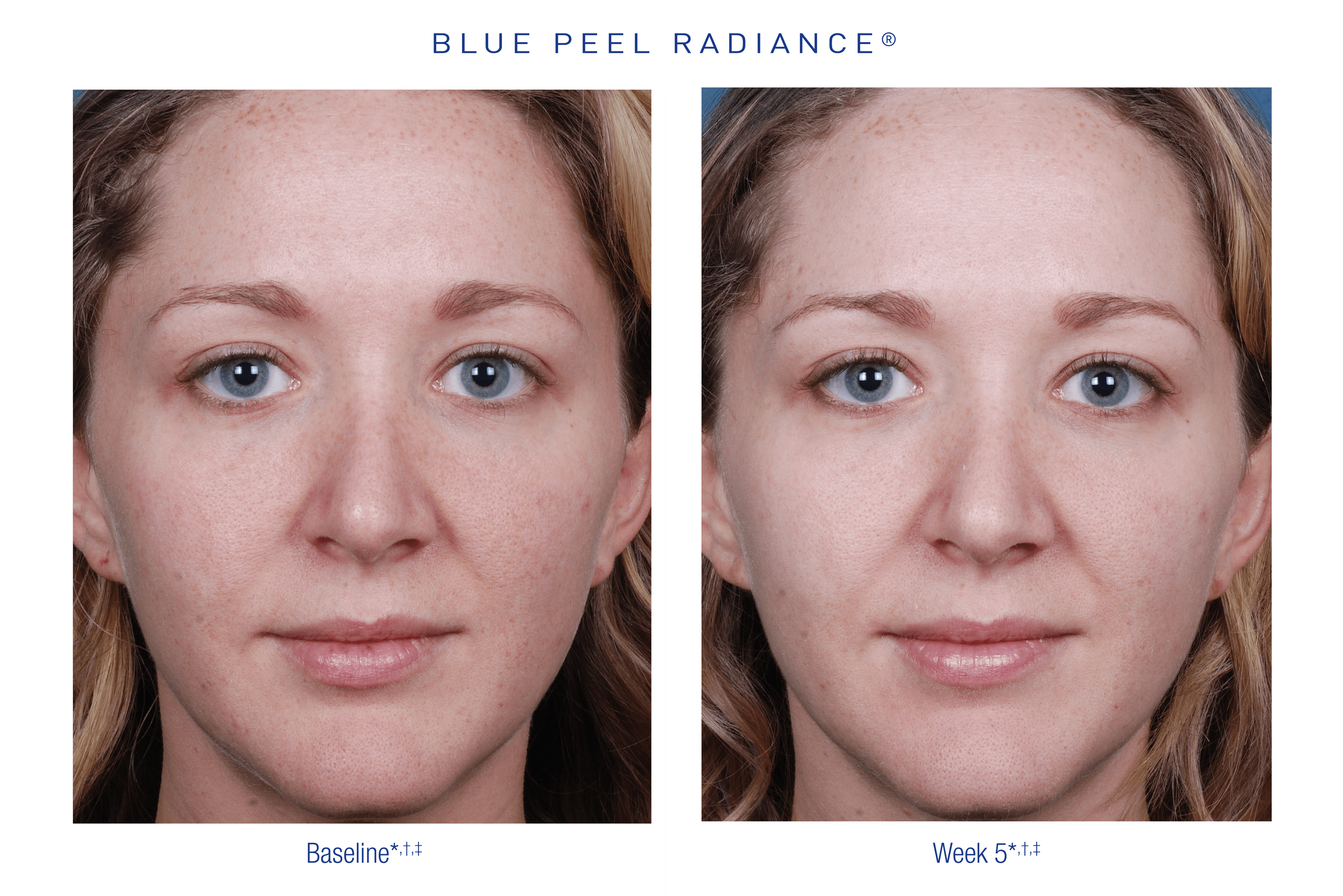 Before and after 3 Obagi peels