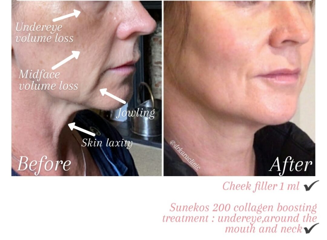 Facial rejuvenation - using dermal filler and Sunekos skin booster by Dr Kara Cosmetic Clinic , Norwich , Norfolk , UK
