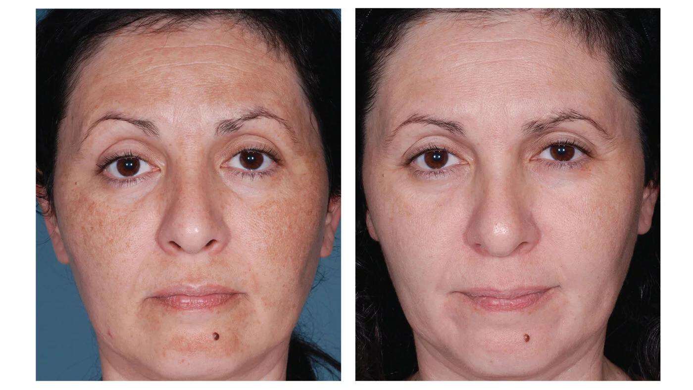 Sun damage - Dr Kara Cosmetic Clinic