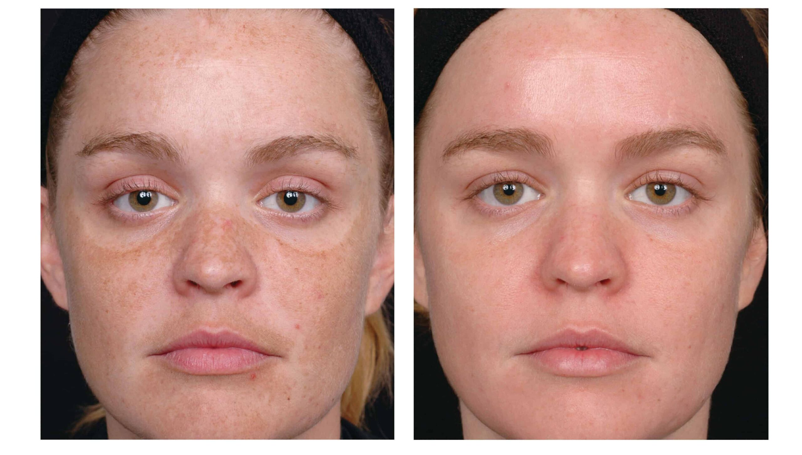 Tretinoin Before And After Tretinoin Before And After