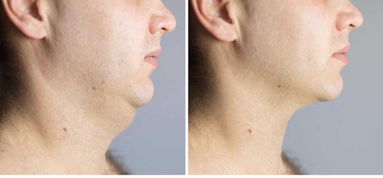 Aqualyx chin fat dissolving before and after result
