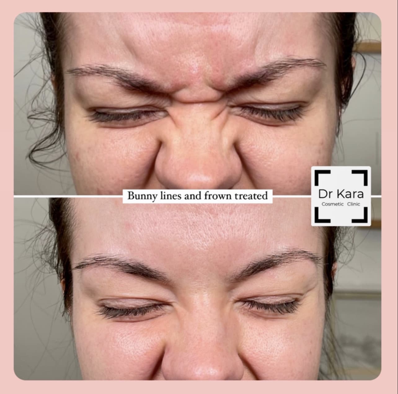 Frown and bunny line botox anti-wrinkleby Dr Kara Cosmetic Clinic , Norwich , UK