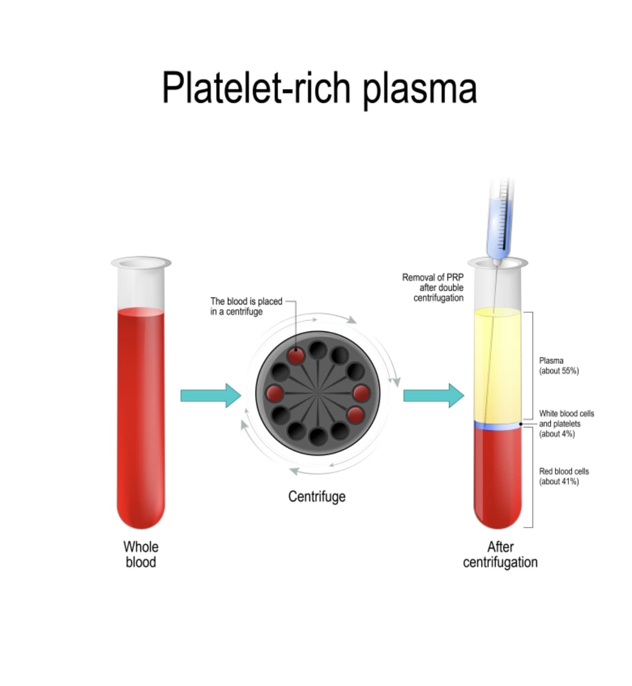 Platelet rich plasma process