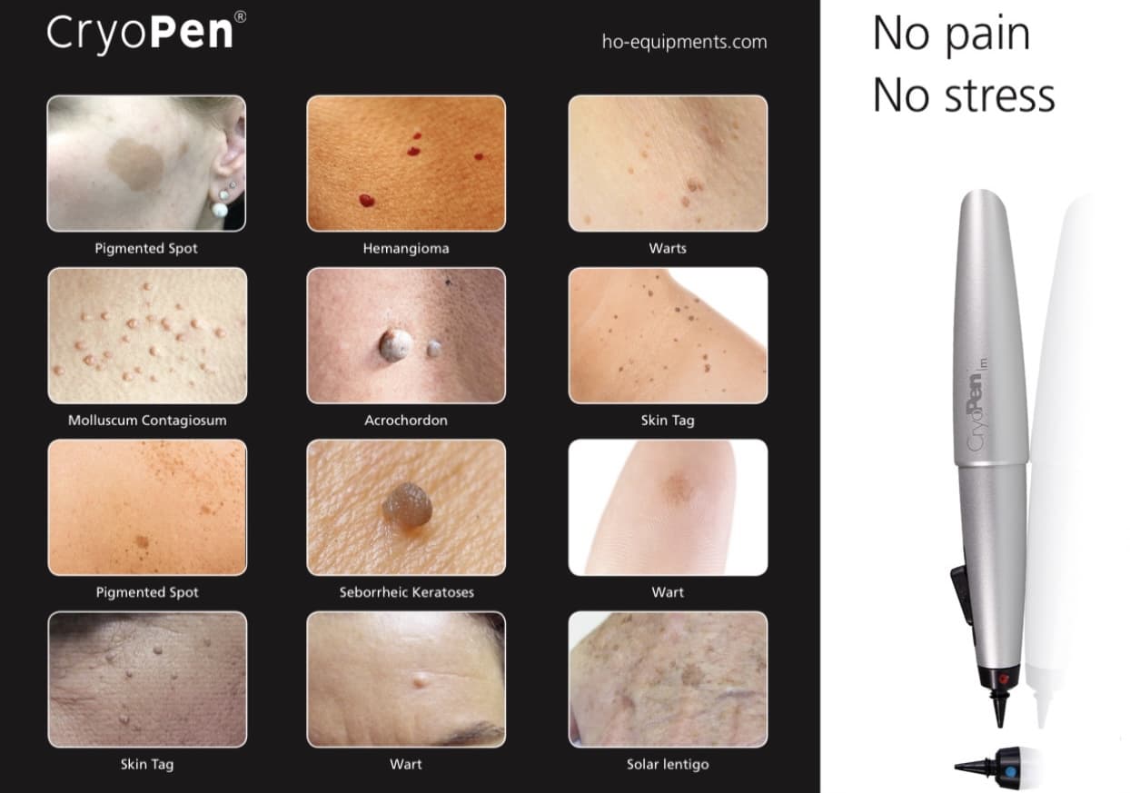 Cryopen - what skin lesions that can be treated