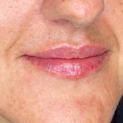 Lip filler result by Dr Kara Cosmetic Clinic in Norwich, Norfolk, UK
