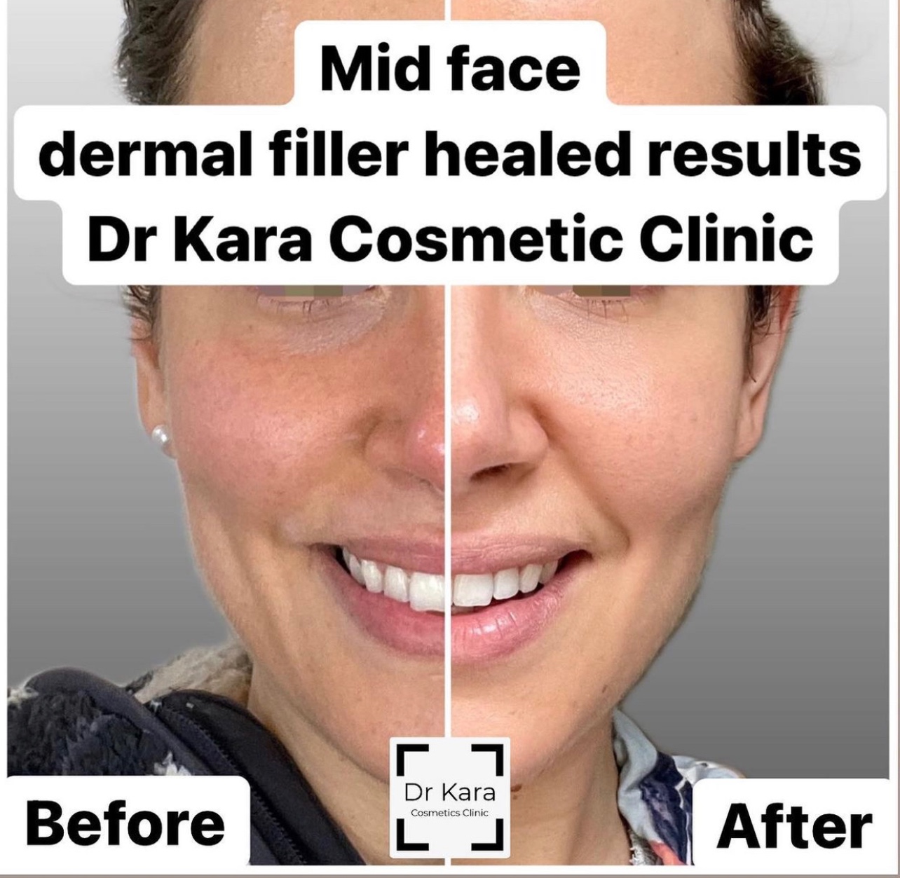Dr Kara Cosmetic Clinic- Mid face tear trough and cheek dermal filler healed results