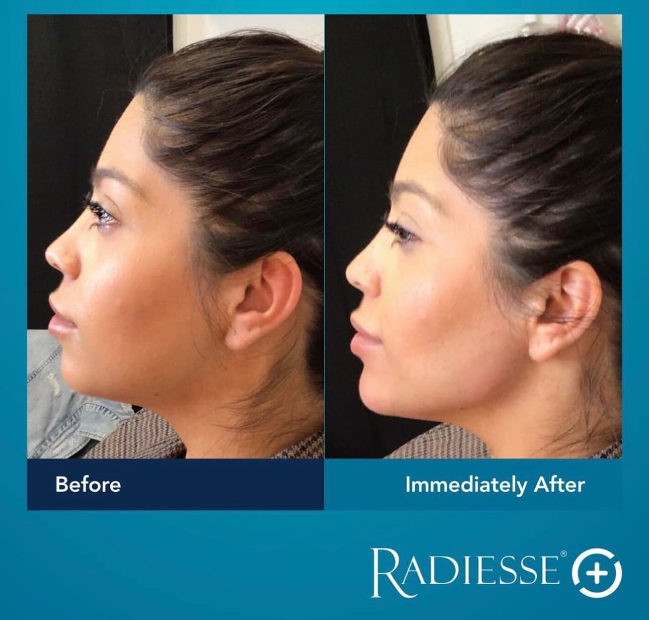 Radiesse Norwich Norfolk lower face rejuvenation jawline and chin female before and after