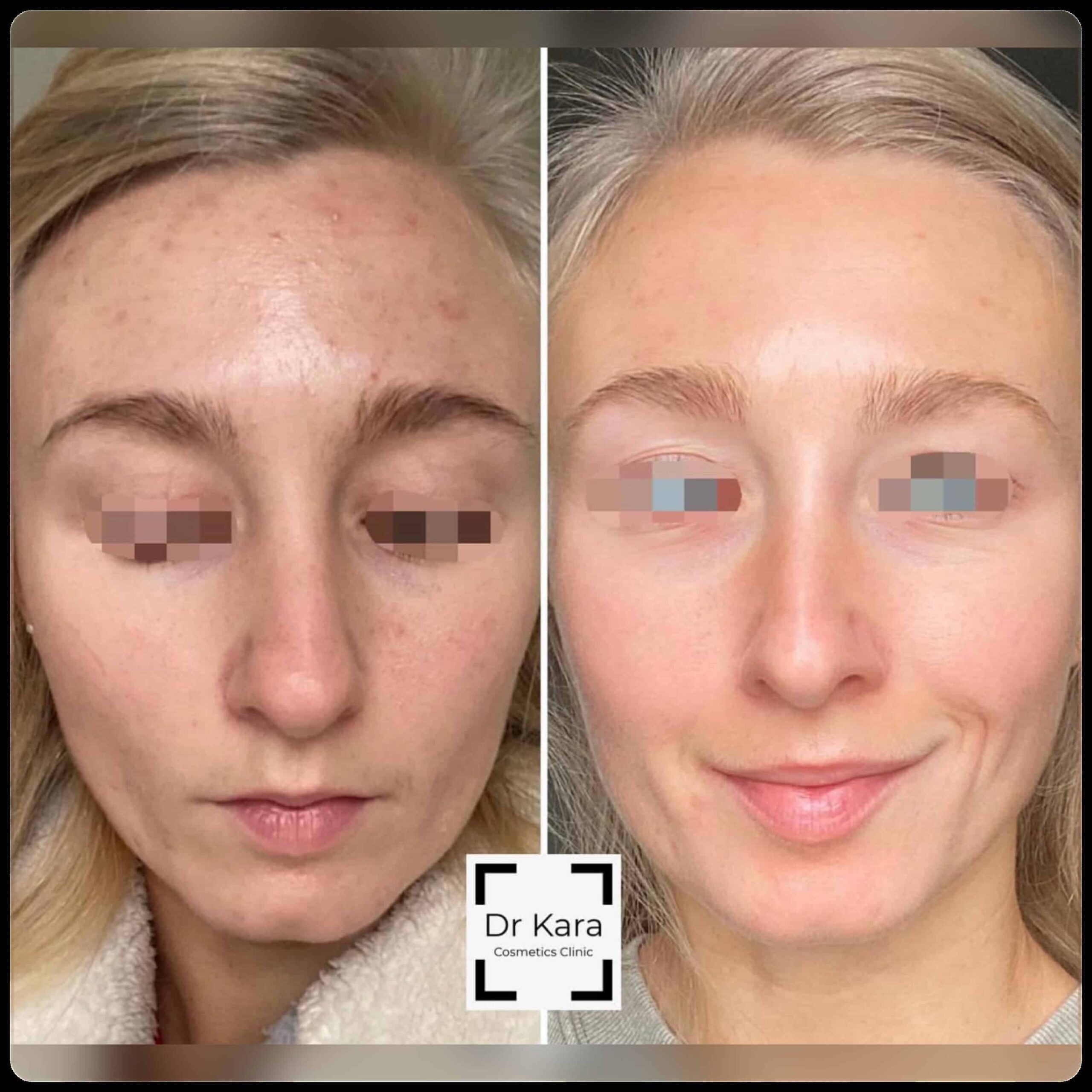 Skincare result by Dr Kara Cosmetic Clinic , Norwich , Norfolk