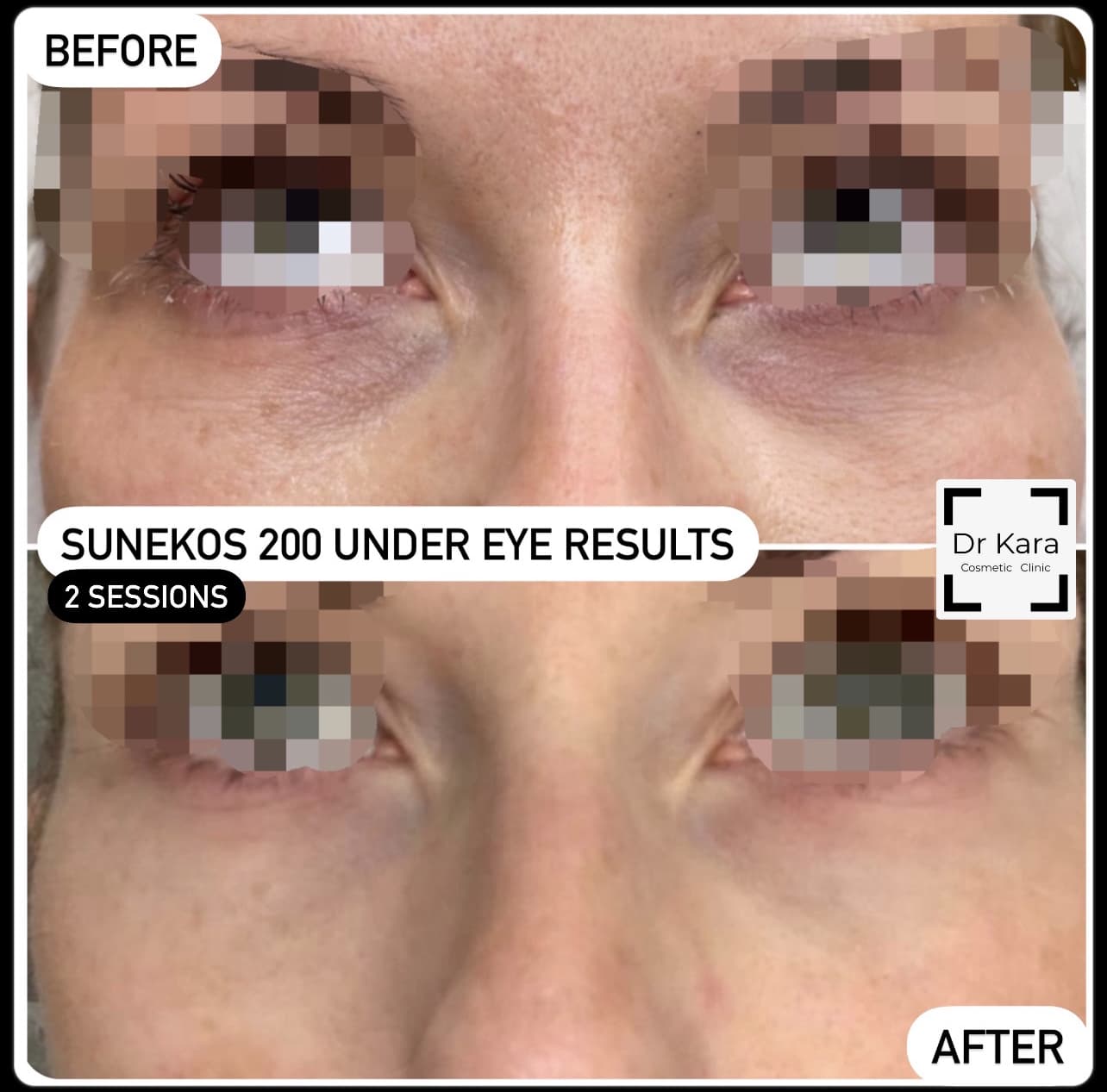 Sunekos Undereye healed result by Dr Kara Cosmetic Clinic , Norwich , Norfolk