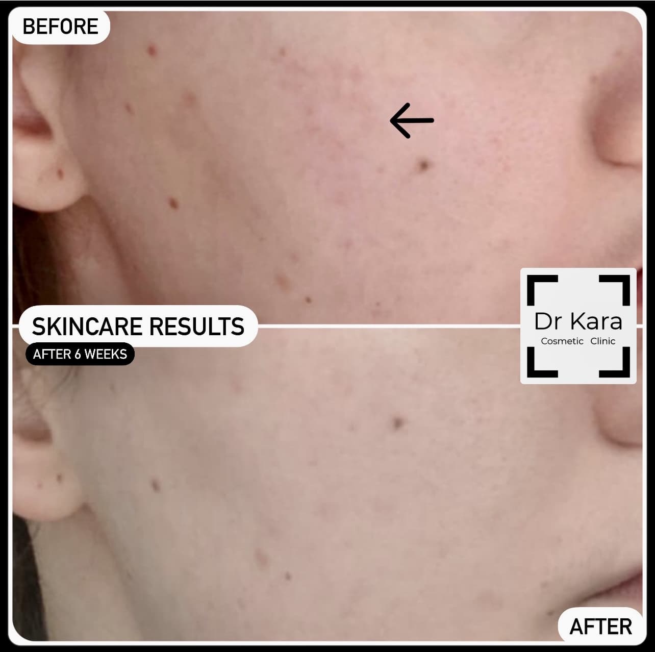 Skincare result by Dr Kara Cosmetic Clinic , Norwich , Norfolk