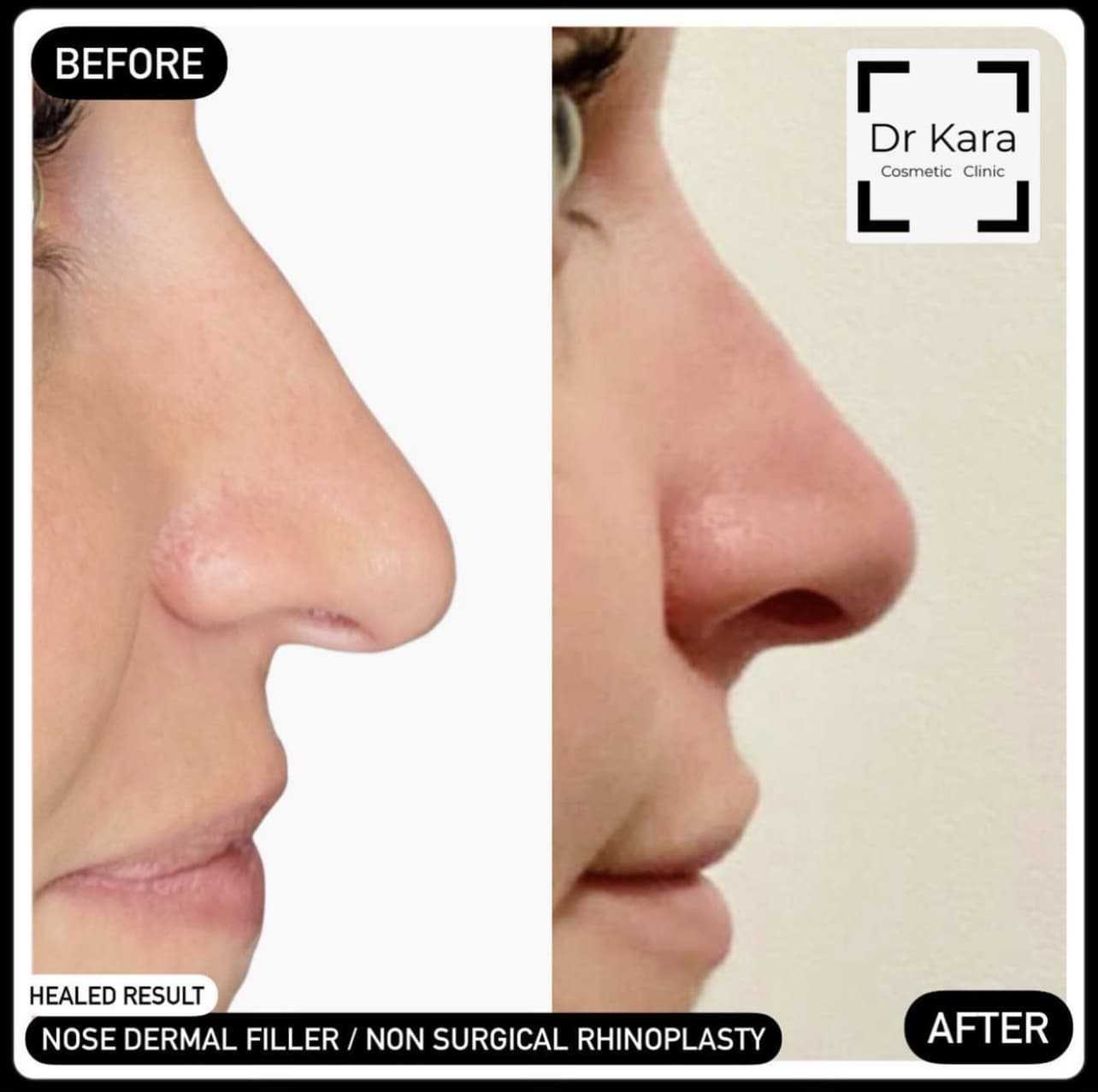 Non surgical rhinoplasty / nose dermal filler by Dr Kara Cosmetic Clinic , Norwich , Norfolk