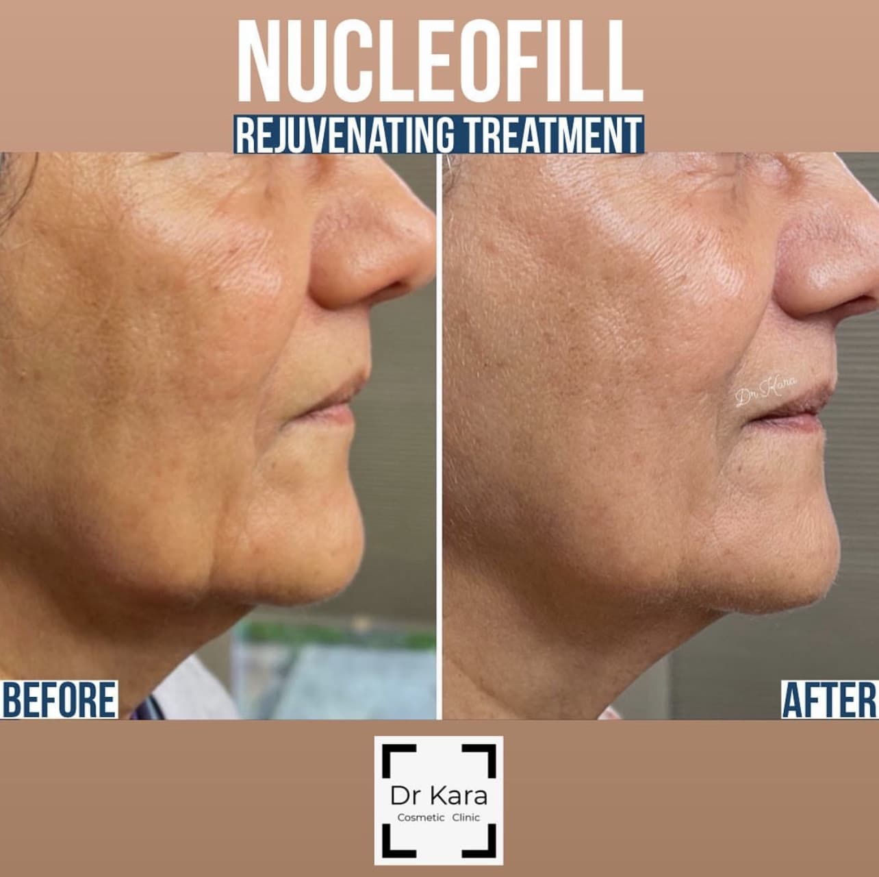 Nucleofill mid to lower face healed result by Dr Kara Cosmetic Clinic , Norwich, Norfolk