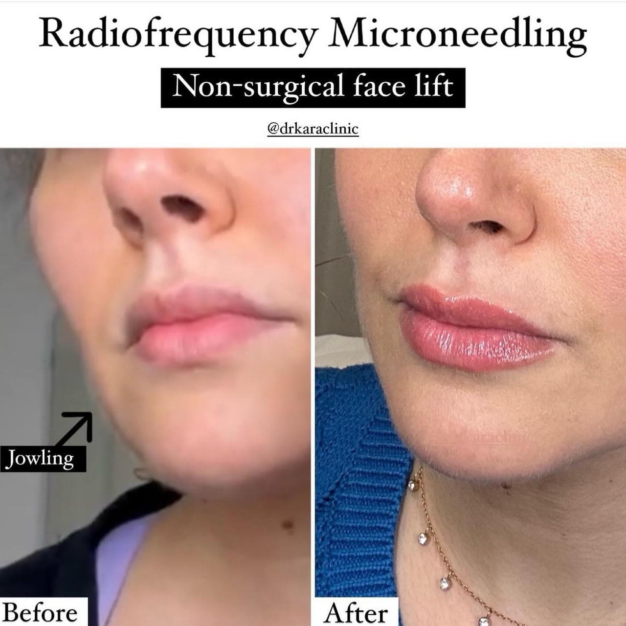 Radiofrequency microneedling face jowling result in Norwich,Norfolk, UK by PureDerma