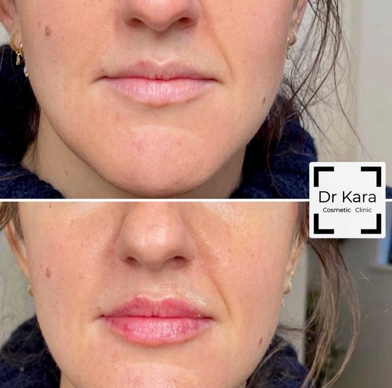Lip filler before and after result by Dr Kara Cosmetic Clinic in Norwich, Norfolk, UK