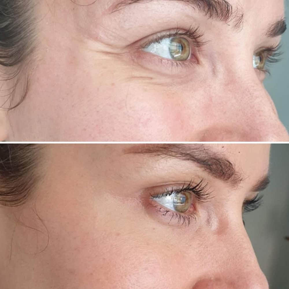 Botox result before and after by Dr Kara Cosmetic Clinic in Norwich , Norfolk
