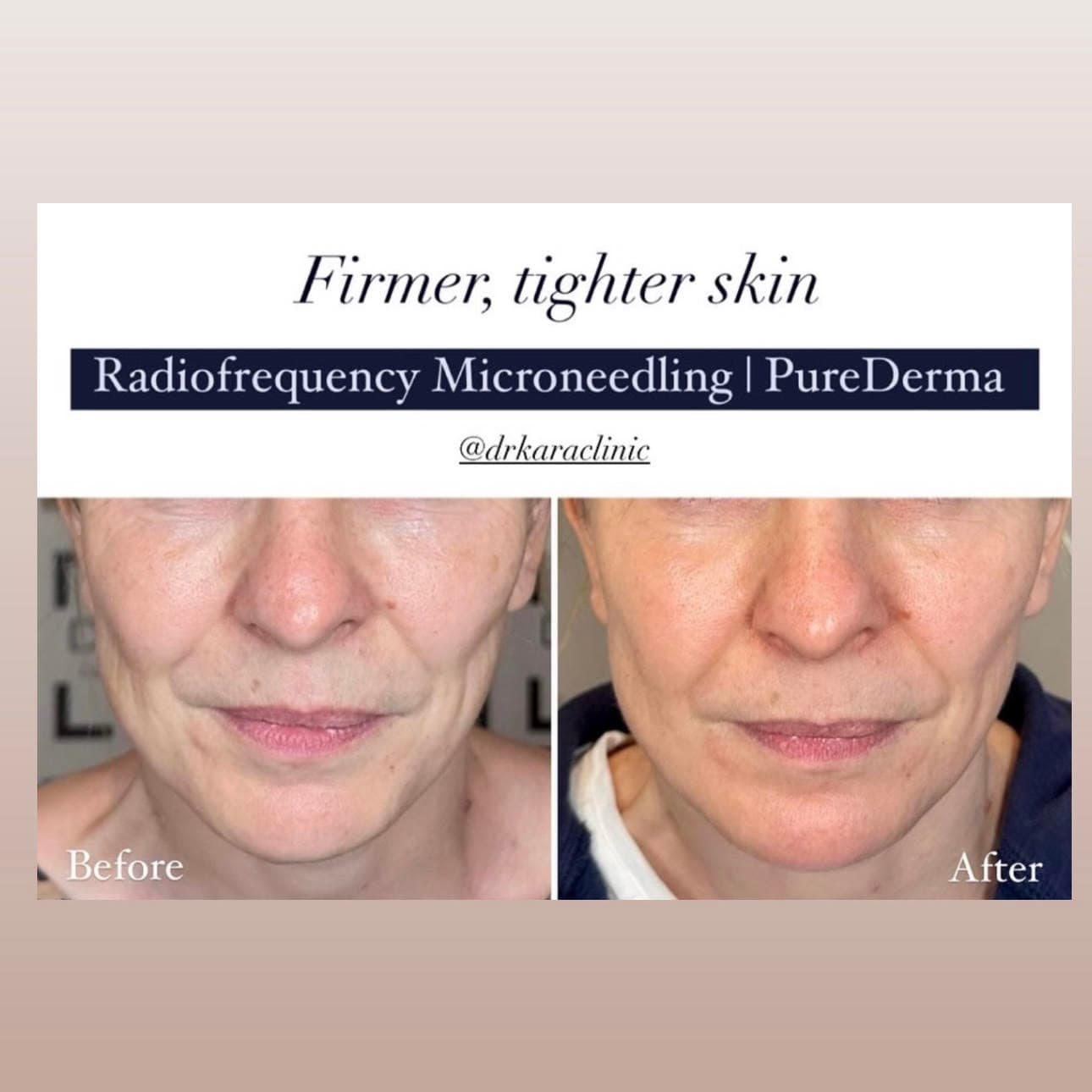 Radiofrequency microneedling face result in Norwich,Norfolk, UK by PureDerma