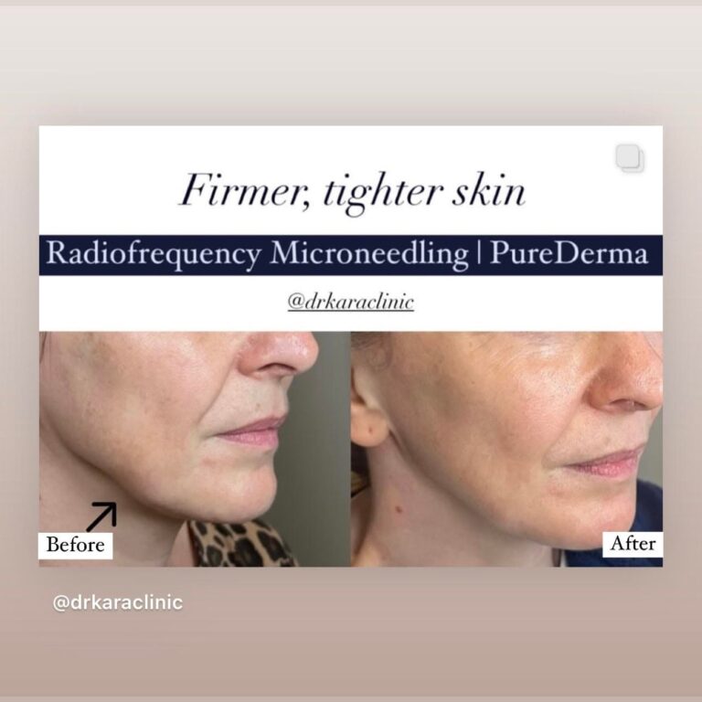 Radiofrequency microneedling face result in Norwich,Norfolk, UK by PureDerma