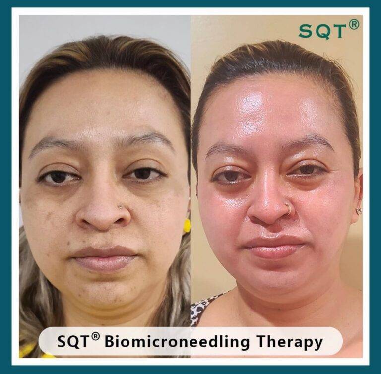 SQT Bio Microneedling - Dr Kara Cosmetic Clinic