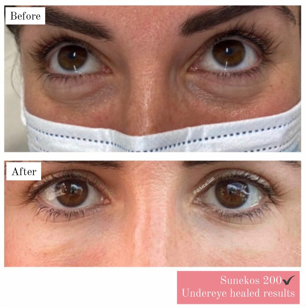 Sunekos skin booster under eye results