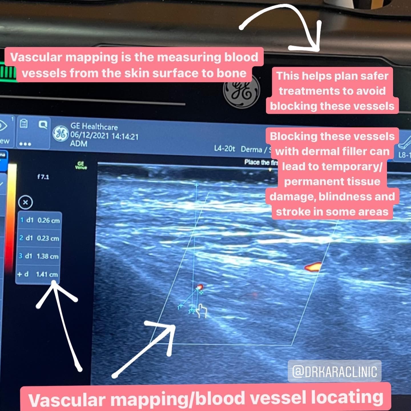 Vascular mapping using facial aesthetic / cosmetic ultrasound by Dr Kara Cosmetic Clinic